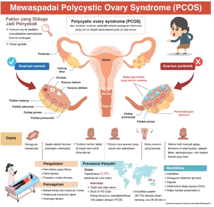 Kenali Gangguan Hormon Pcos